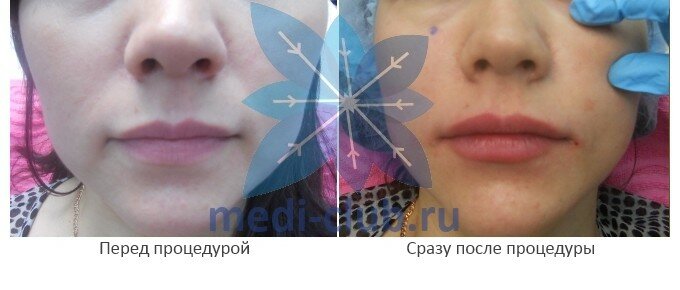уколы в губы фото до и после
