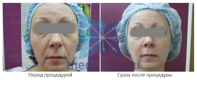 коррекция носогубных складок фото до и после